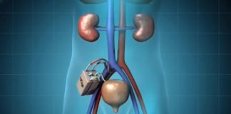 მედიცინის მიღწევა-ხელოვნური თირკმელი ,რომლის იმპლანტირების შემდეგ დიალეზი საჭირო არ იქნება