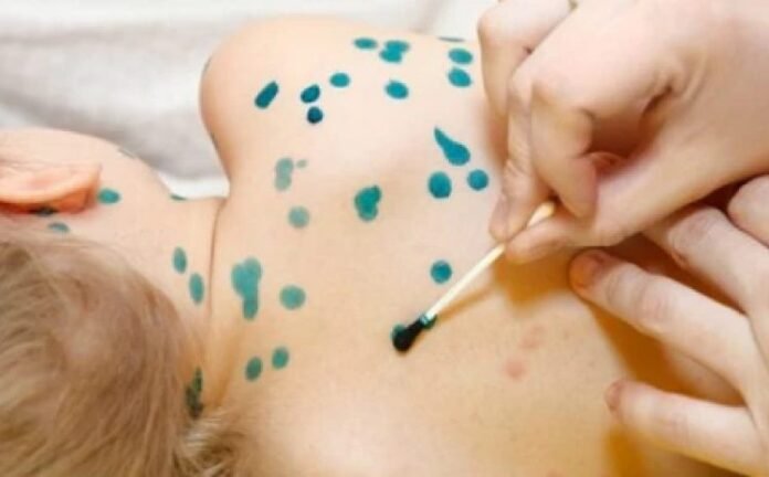 ჩუტყვავილა